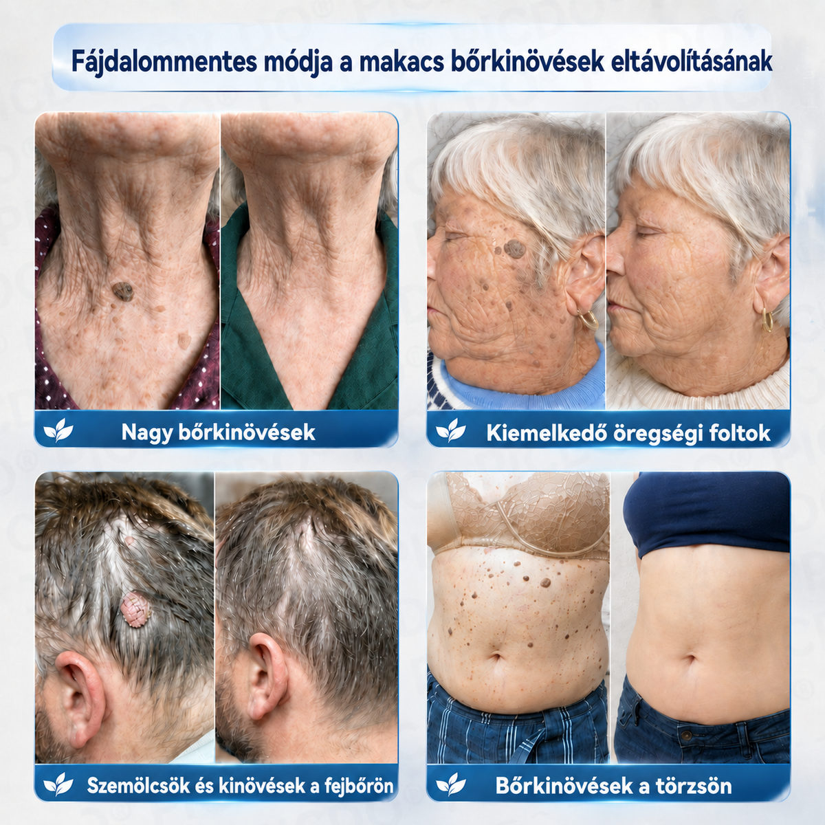 Picdo® 7 napos krém bőrkinövések és pigmentfoltok eltávolítására 🧴 (Fájdalommentes formula – hegek nélkül)