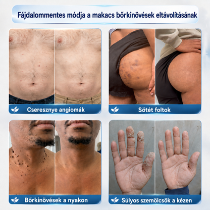 Picdo® 7 napos krém bőrkinövések és pigmentfoltok eltávolítására 🧴 (Fájdalommentes formula – hegek nélkül)