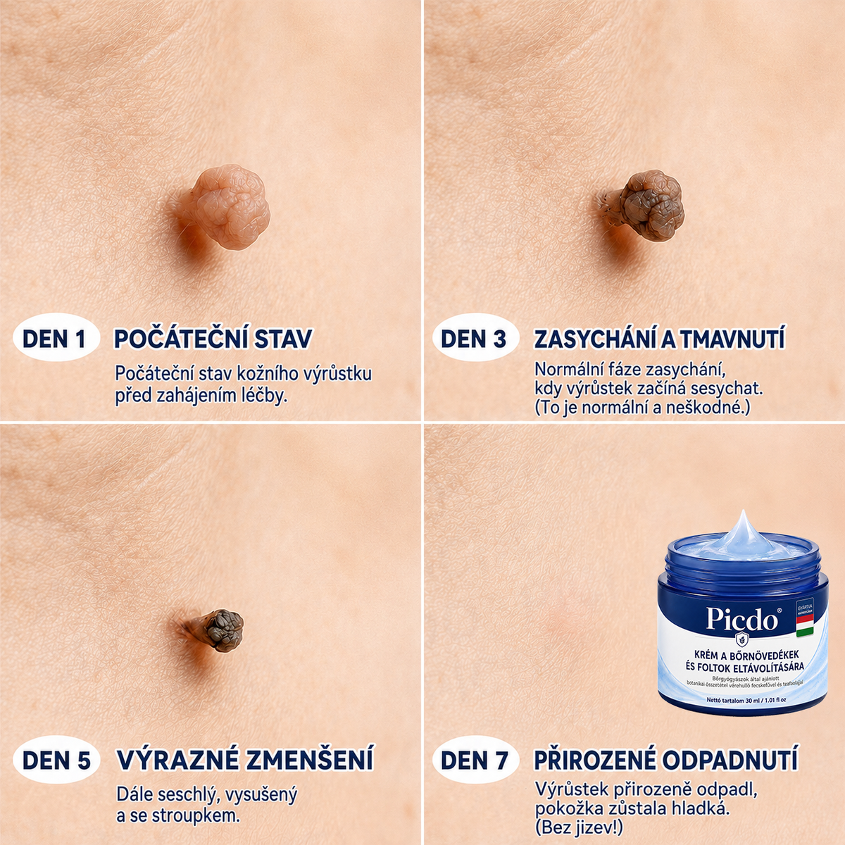Picdo® 7 napos krém bőrkinövések és pigmentfoltok eltávolítására 🧴 (Fájdalommentes formula – hegek nélkül)